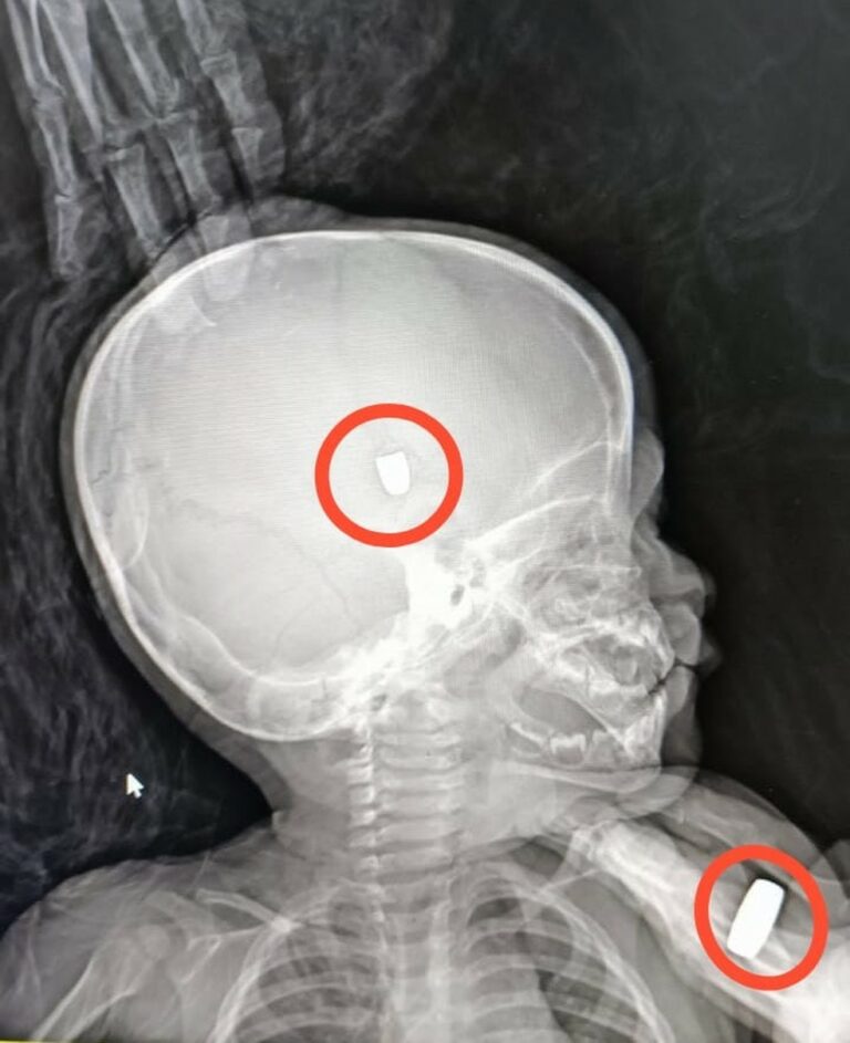 Bebê de um ano é baleado na cabeça após criminosos invadirem casa de família