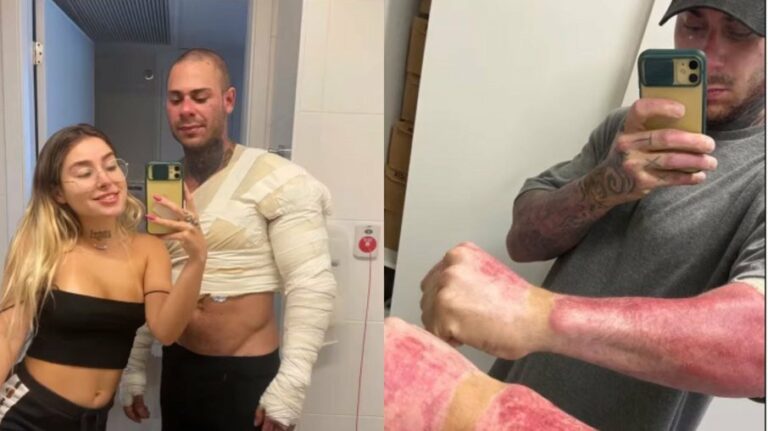 Leo Stronda mostra ferimentos após explosão: “Voltado a me reconhecer”