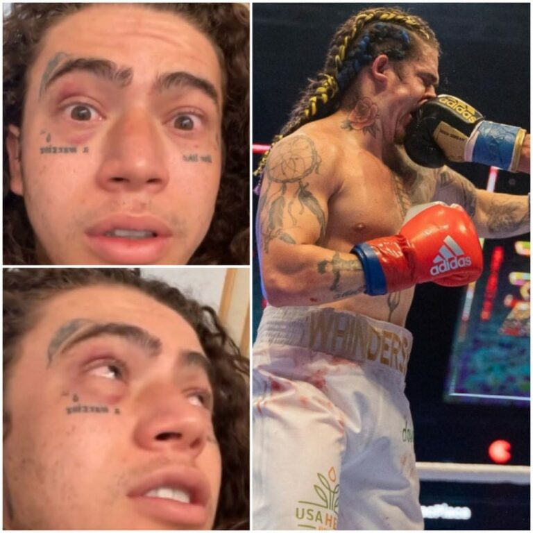 Whindersson mostra rosto ainda castigado por pancadas e olhos vermelhos após luta com Popó