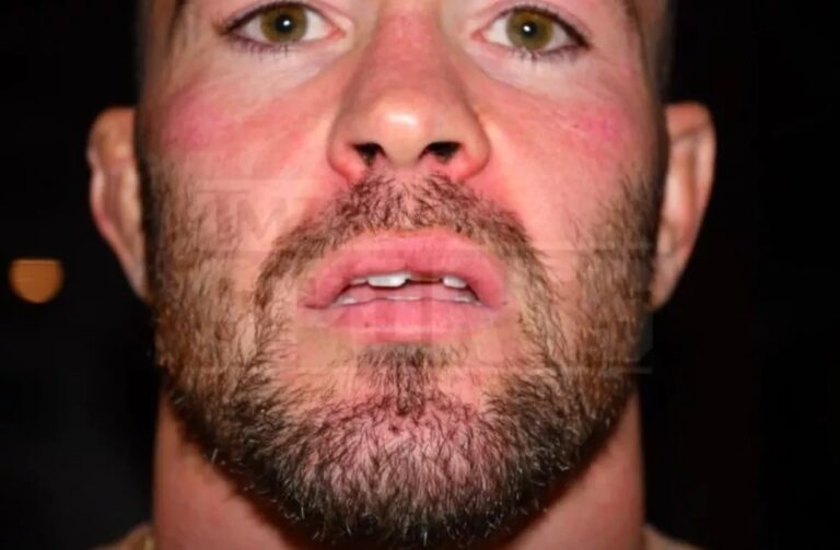 Site mostra fotos inéditas de Colby Covington com dentes quebrados após suposta agressão de Masvidal