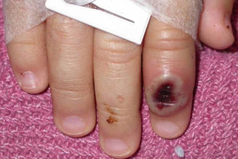 Portugal identifica 5 casos de varíola dos macacos; Espanha tem 23 suspeitos