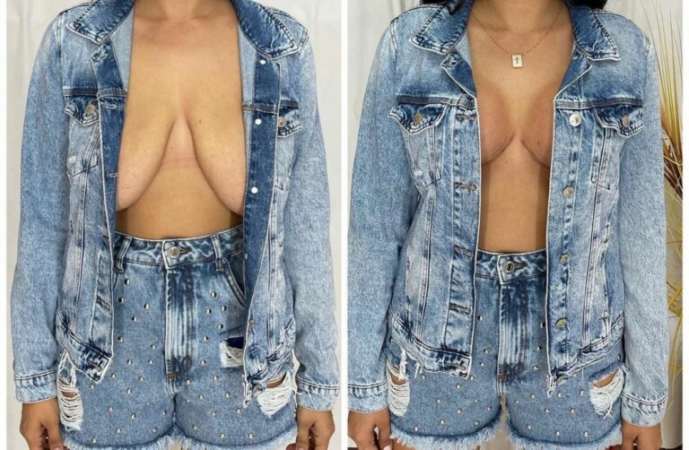 Blogueira acreana posta foto comparando corpo antes e depois de cirurgia plástica