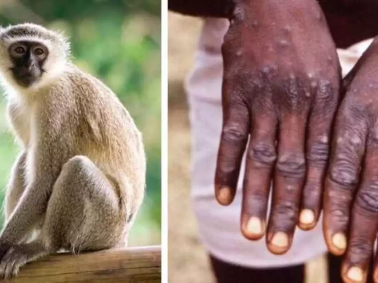 Após Bolívia registrar caso suspeito de varíola do macaco, Sesacre diz que está em vigilância