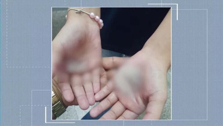 Mãe é suspeita de queimar mãos de filha com colher quente
