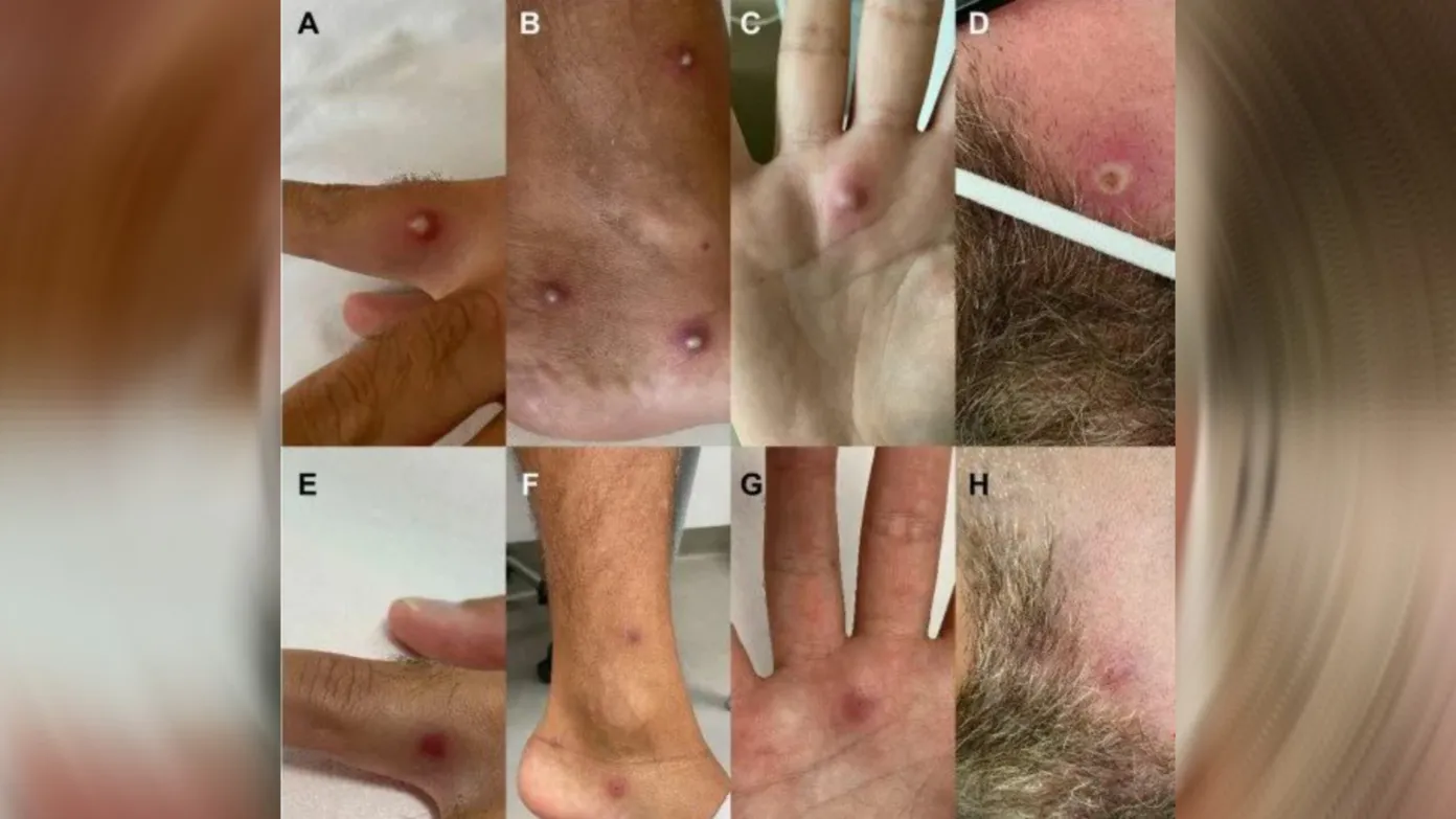 Italiano testa positivo para varíola dos macacos, Covid e HIV após sexo sem proteção