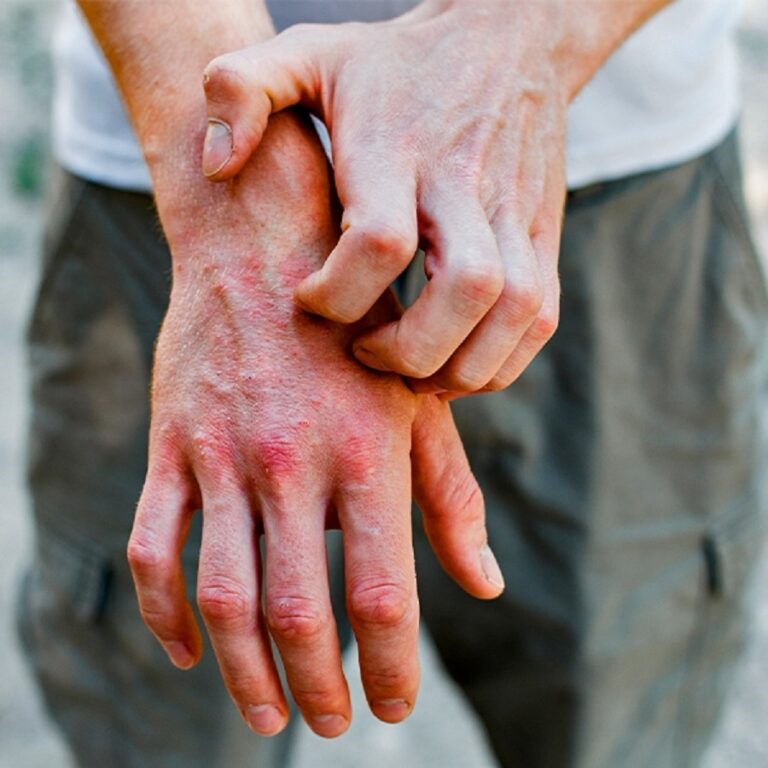 Família inteira é investigada e caso de hanseníase é confirmado no Acre