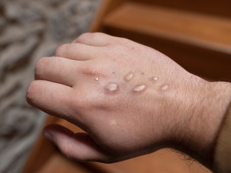 Criança de 6 anos é mais um caso suspeito de varíola do macaco no Acre