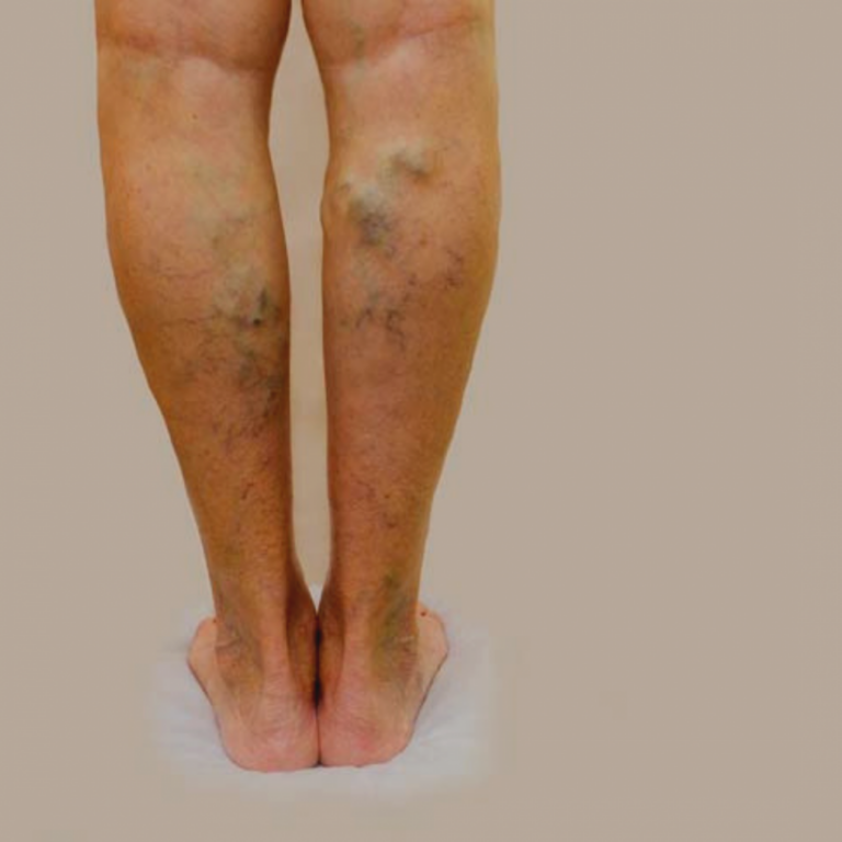 Acre está entre os estados com menor número de internação por trombose venosa