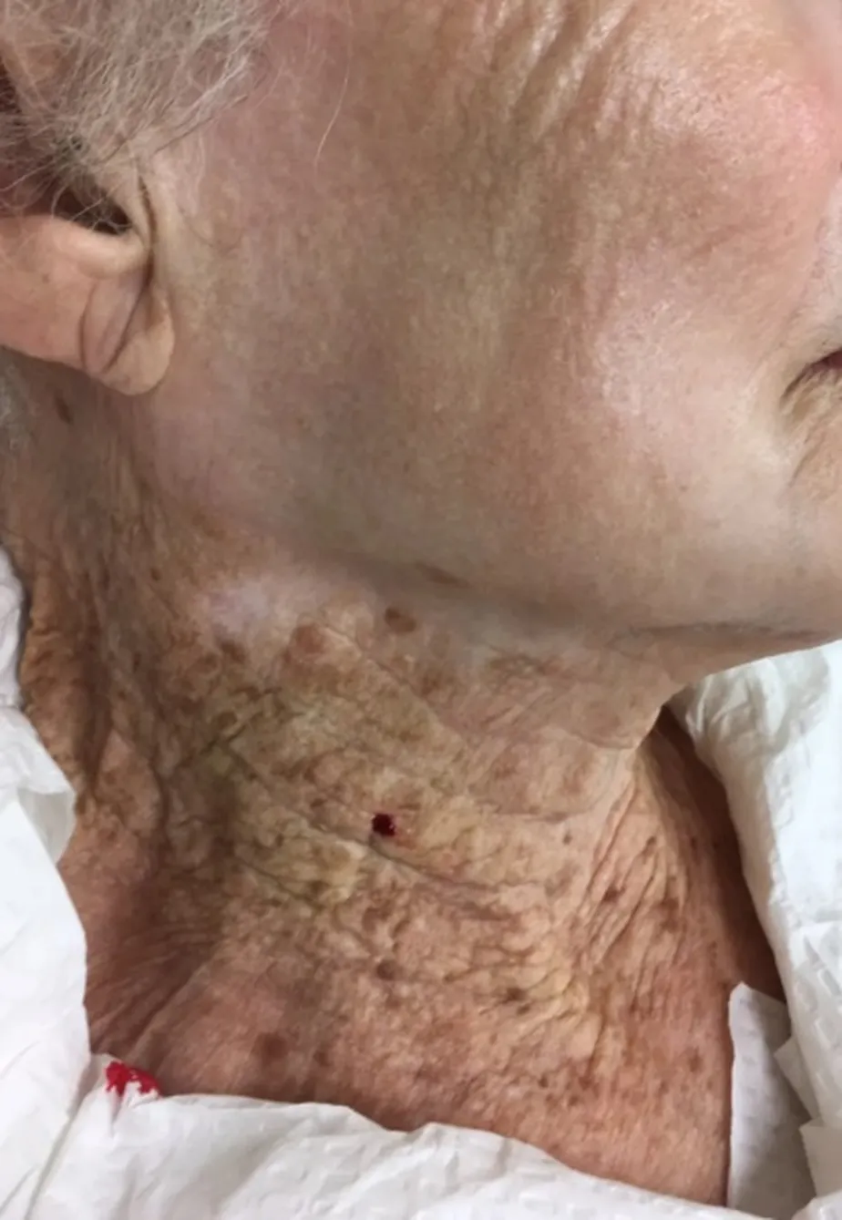 Idosa passa a vida passando protetor solar em uma só parte do corpo e diferença viraliza: FOTO