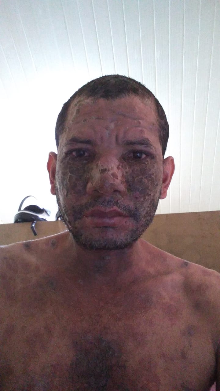 No Acre, homem com doença desconhecida pede ajuda para realizar tratamento