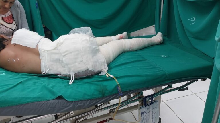 Crianças e pais que tiveram queimaduras graves apĂłs incĂȘndio sĂŁo encaminhadas para Rio Branco