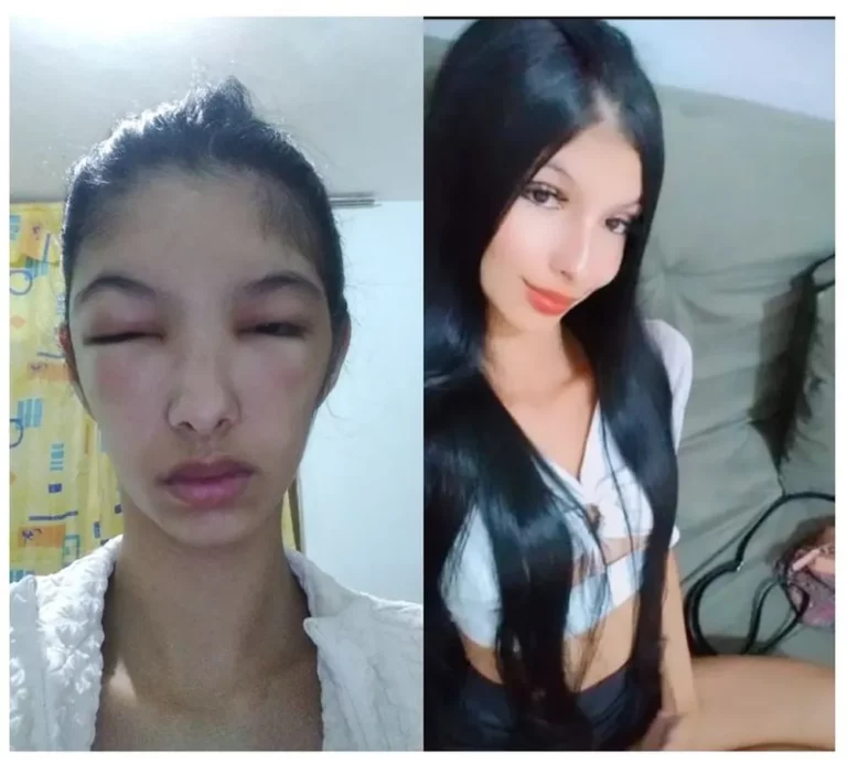 Estudante tem rosto deformado após sofrer reação alérgica ao usar tinta para cabelo