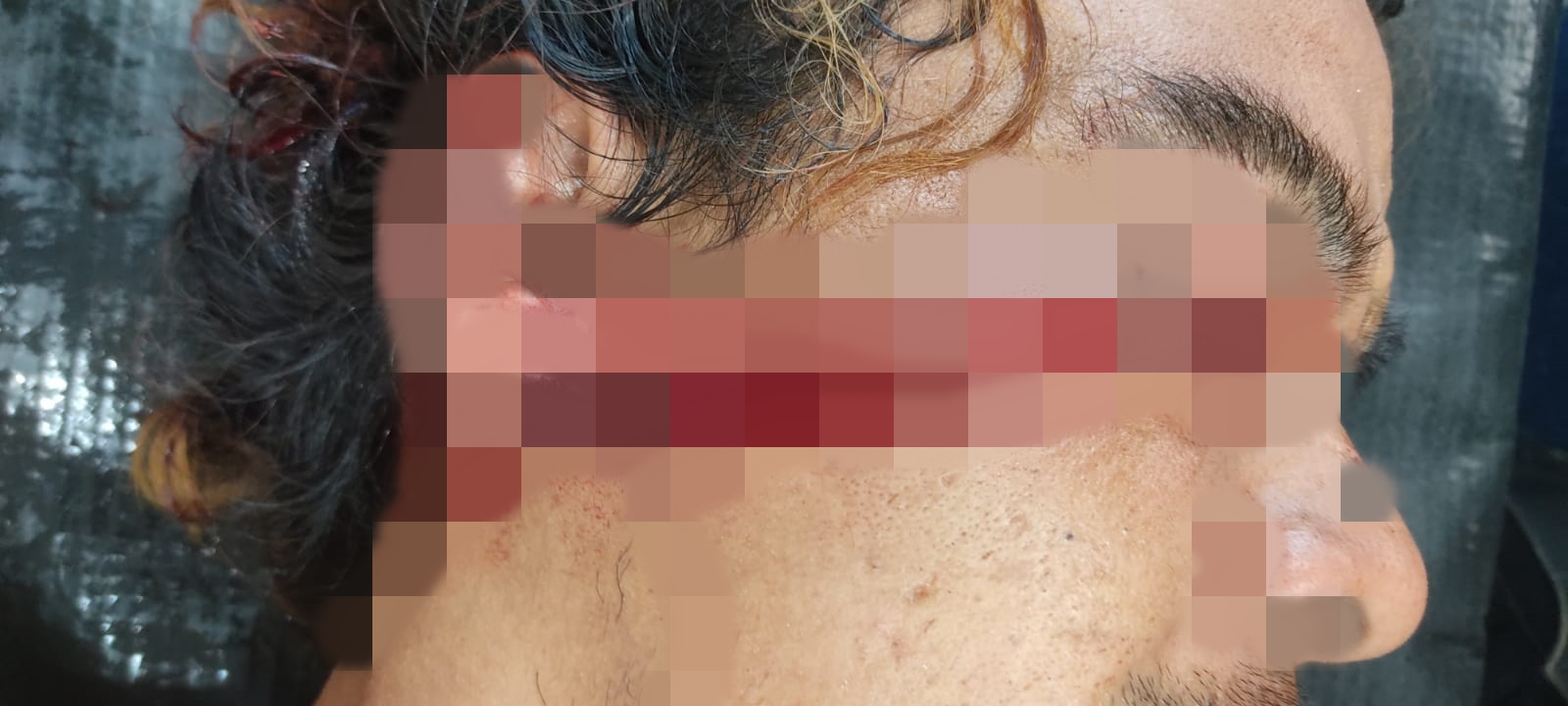 VÍDEO: mulher trans recebe terçadada enquando dormia no Calçadão e fica cega VÍDEO: mulher trans recebe terçadada enquando dormia no Calçadão e fica cega