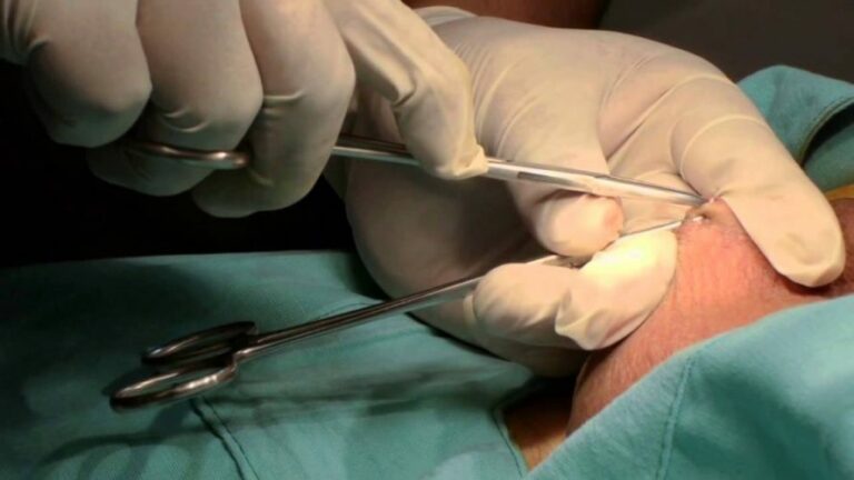 Nova lei dispensa aval do cônjuge e reduz idade mínima para laqueadura e vasectomia