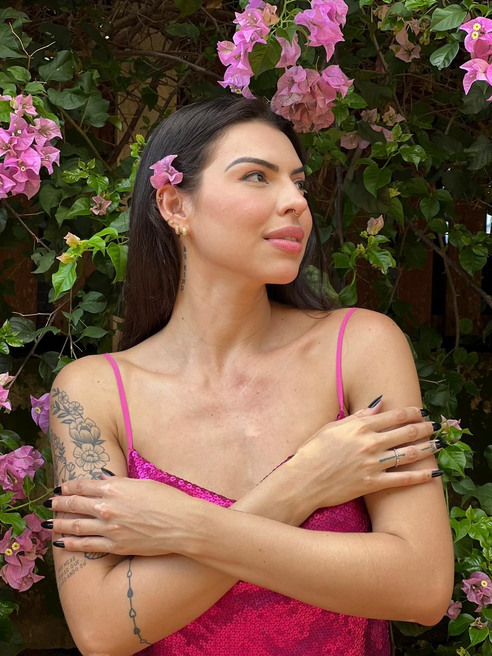 Dia Mundial do Vitiligo: Miss Acre fala sobre a doença e dificuldade para diagnóstico