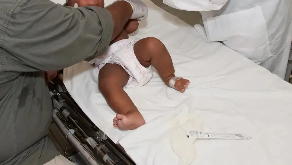 Bebê quase perde ponta do pênis por causa de fio de cabelo da mãe; entenda