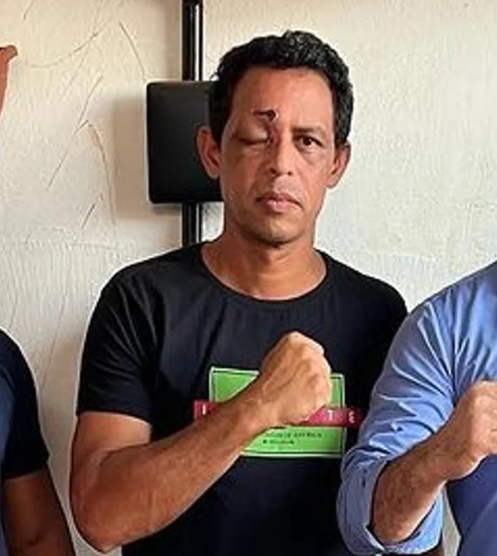 Policial atingido por tiro no olho durante rebelião faz campanha para realizar tratamento