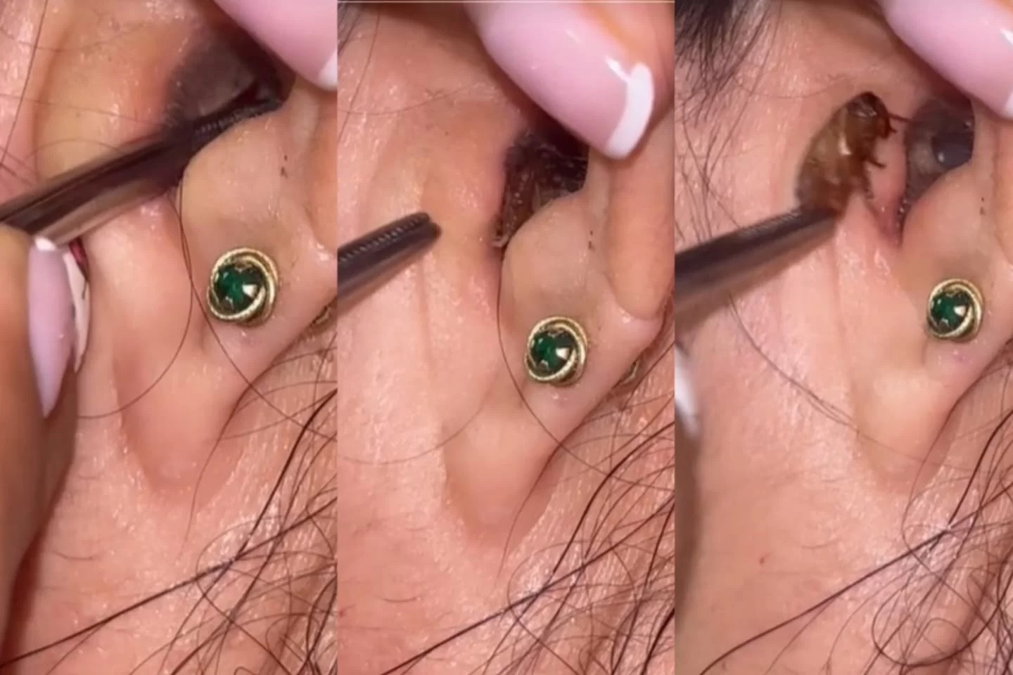 Vídeo: médica mostra barata encontrada dentro da orelha de paciente