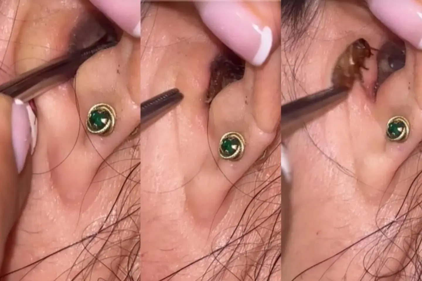 Vídeo: médica mostra barata encontrada dentro da orelha de paciente