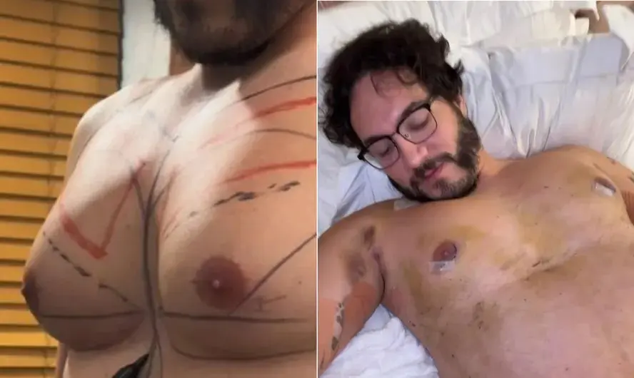 Veja o antes e depois de Eliezer após ginecomastia e lipoaspiração; entenda os procedimentos