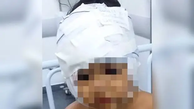 Criança passa por cirurgia após ter rosto dilacerado por pit-bull