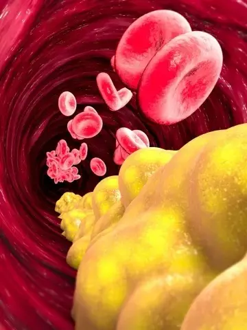 Colesterol ruim: duas injeções anuais reduzem os níveis pela metade