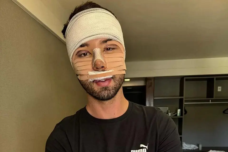 Veja o antes e depois das cirurgias faciais de Rico Melquíades