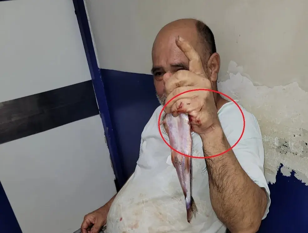 VÍDEO: Ferrão de peixe atravessa mão de idoso: ‘a mesma coisa que levar uma facada’