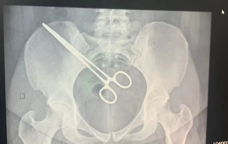 Mulher descobre pinça dentro do corpo ao visitar marido na cadeia
