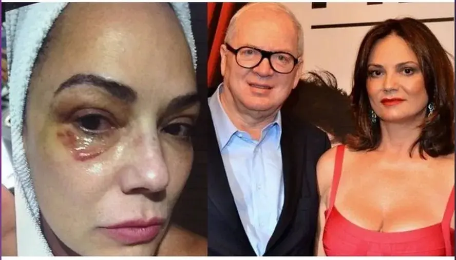 Luiza Brunet pede R$ 1 milhão de indenização de ex-marido por agressão