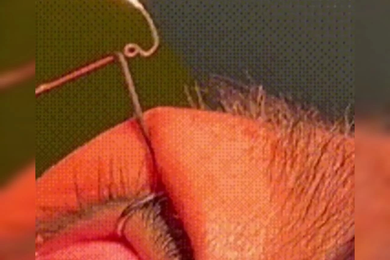 Médicos retiram 60 vermes dos olhos de mulher chinesa; Veja fotos
