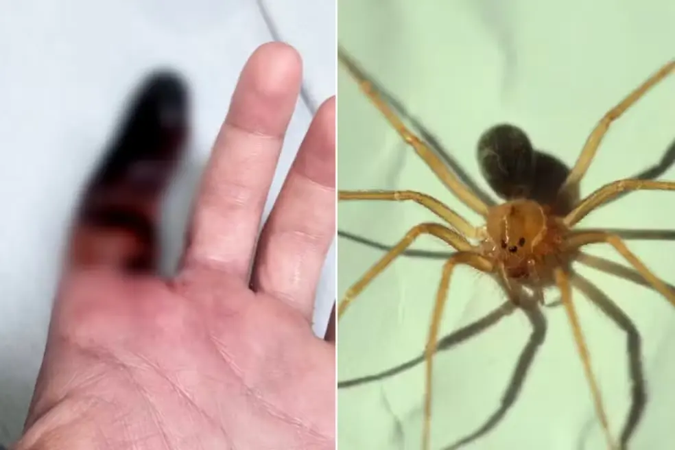 Homem picado por aranha venenosa enquanto dormia terá dedo amputado