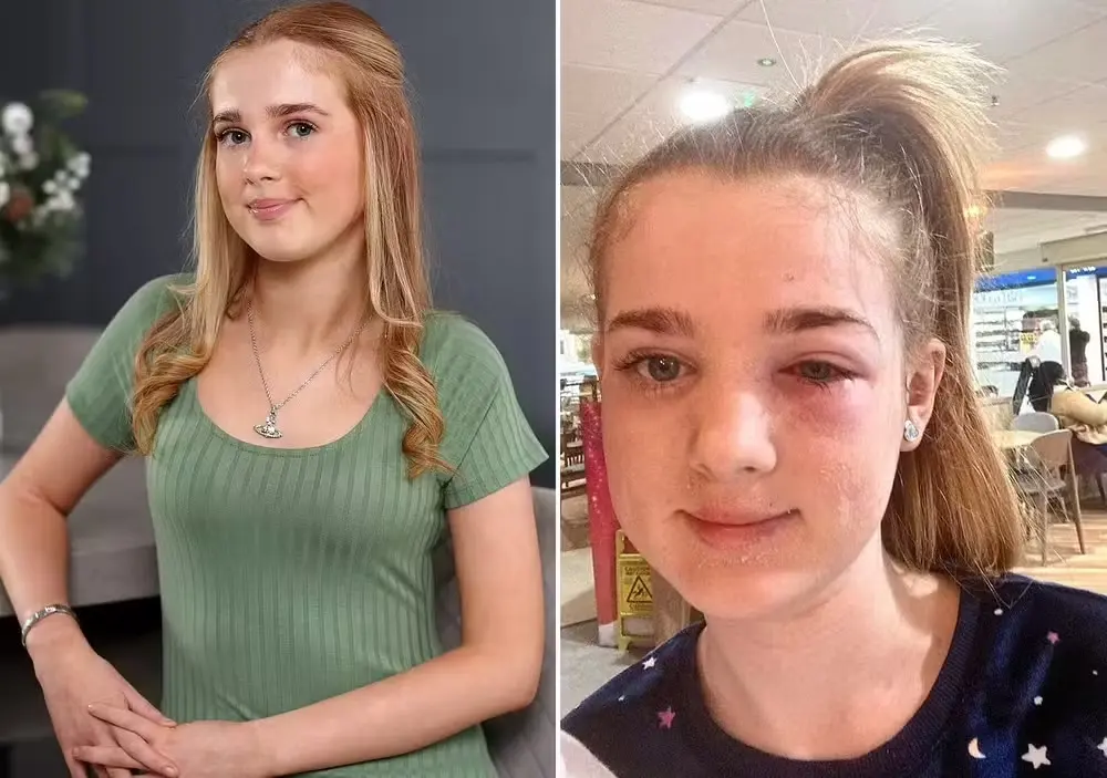 Menina de 13 anos quase fica cega por dica de beleza que viu no TikTok