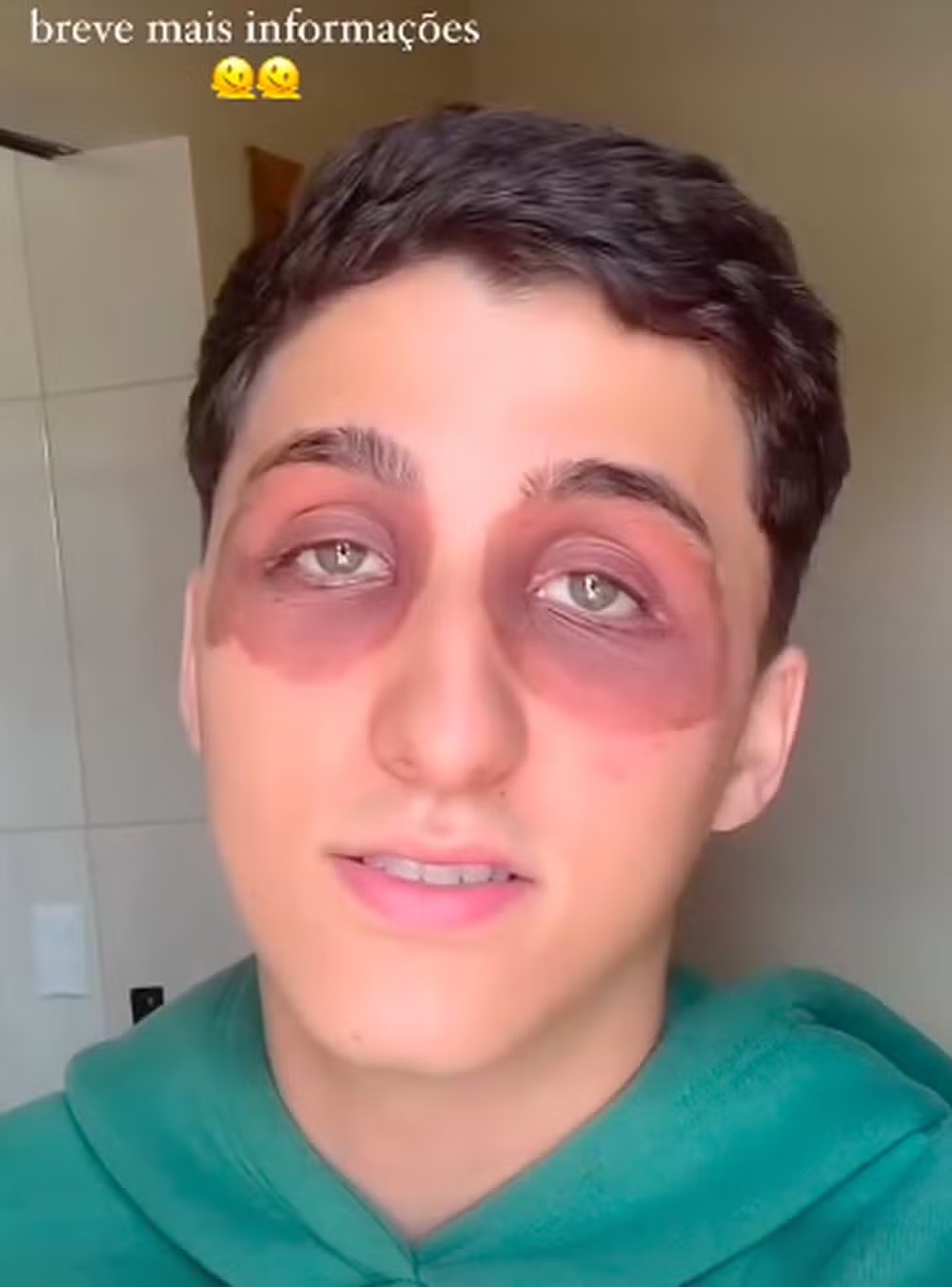 Mordida de barata? Jovem viraliza ao acordar com olhos inchados