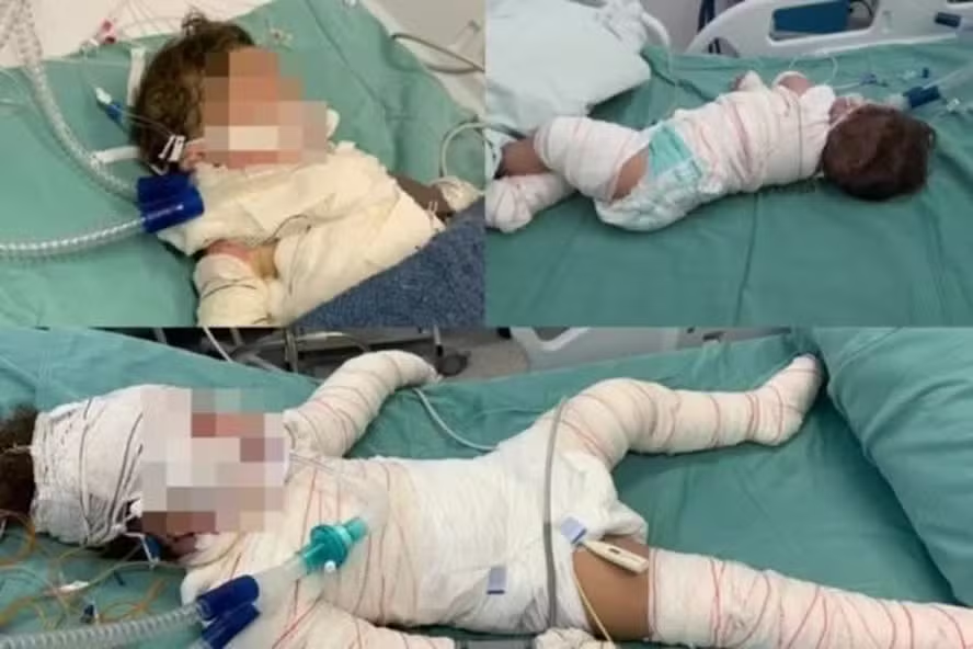 Morre bebê de 11 meses ferido em explosão de churrasqueira