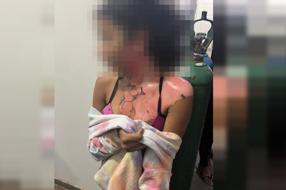 Vídeo chocante: tia queima sobrinha de 13 anos com água fervendo