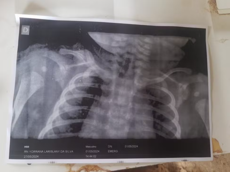 BebĂȘ quebra clavĂcula durante o parto e mĂŁe acusa mĂ©dico de negligĂȘncia na ‘maternidade de lona’