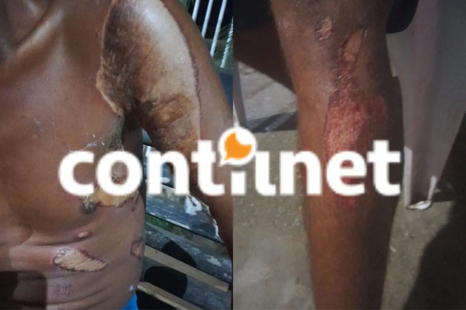 Crueldade: pessoa em situação de rua que dormia sobre um papelão tem corpo queimado por ácido