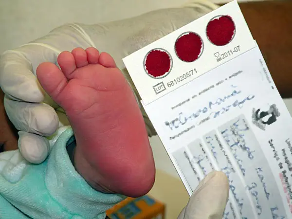 Em 2024, apenas 50% dos bebês nascidos no Acre fizeram teste do pezinho; exame identifica doenças