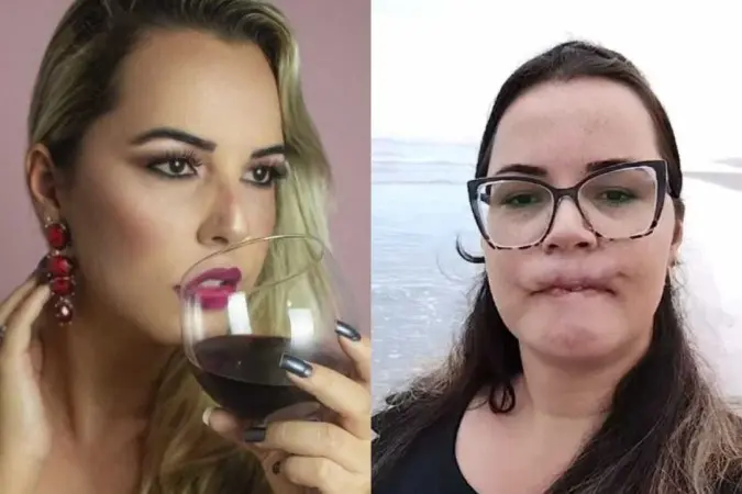 Influenciadora passa por três cirurgias para restaurar lábio após uso de PMMA