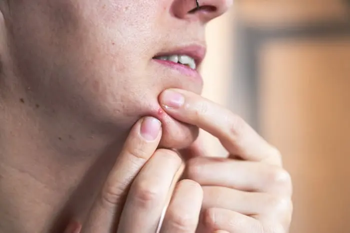 Suplemento de ômega 3 pode ajudar a combater a acne, diz pesquisa