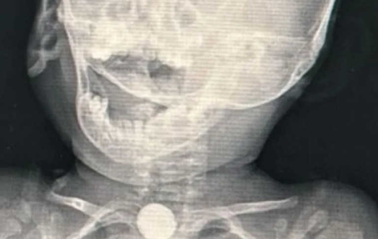 Bebê indígena engole bateria de brinquedo e vai parar no hospital: “Várias lesões graves”