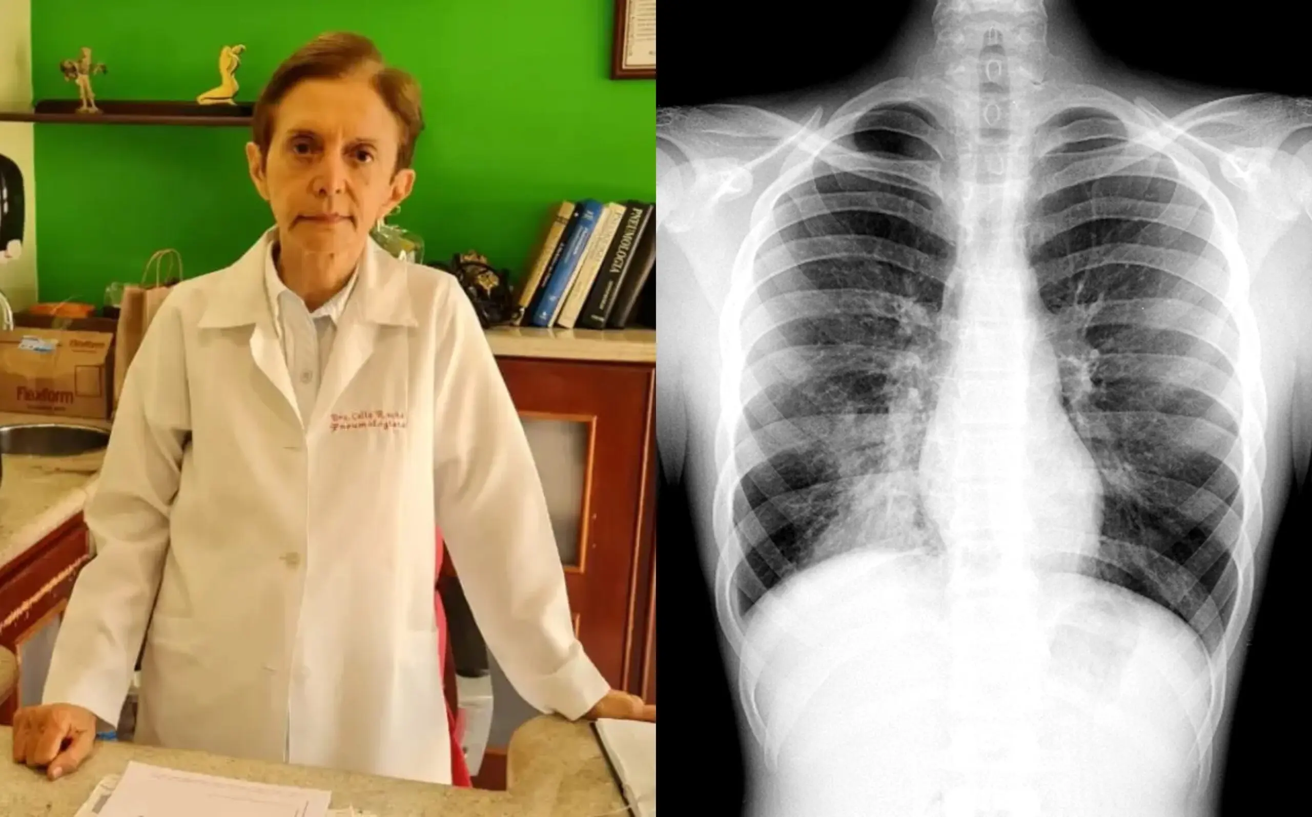 Dia da Pneumonia: especialista do Acre diz que queimadas prejudicaram ainda mais a saúde