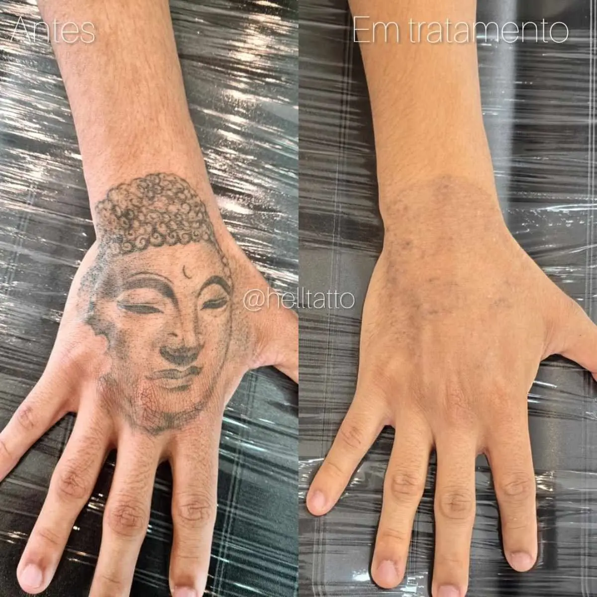 Do arrependimento à remoção: a jornada da retirada de tatuagens