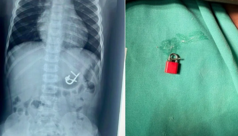 Criança engole cadeado com as chaves e passa por endoscopia para remoção
