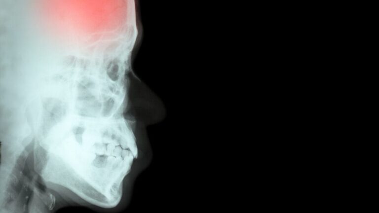 Estudo de SC busca promover alternativa inovadora para tratamento de pacientes de AVC