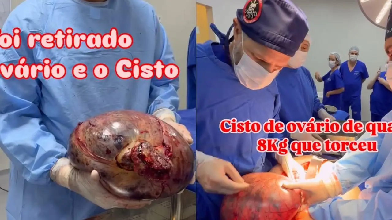 Médico remove cisto de quase 8 kg do ovário de paciente em cirurgia de urgência no Acre