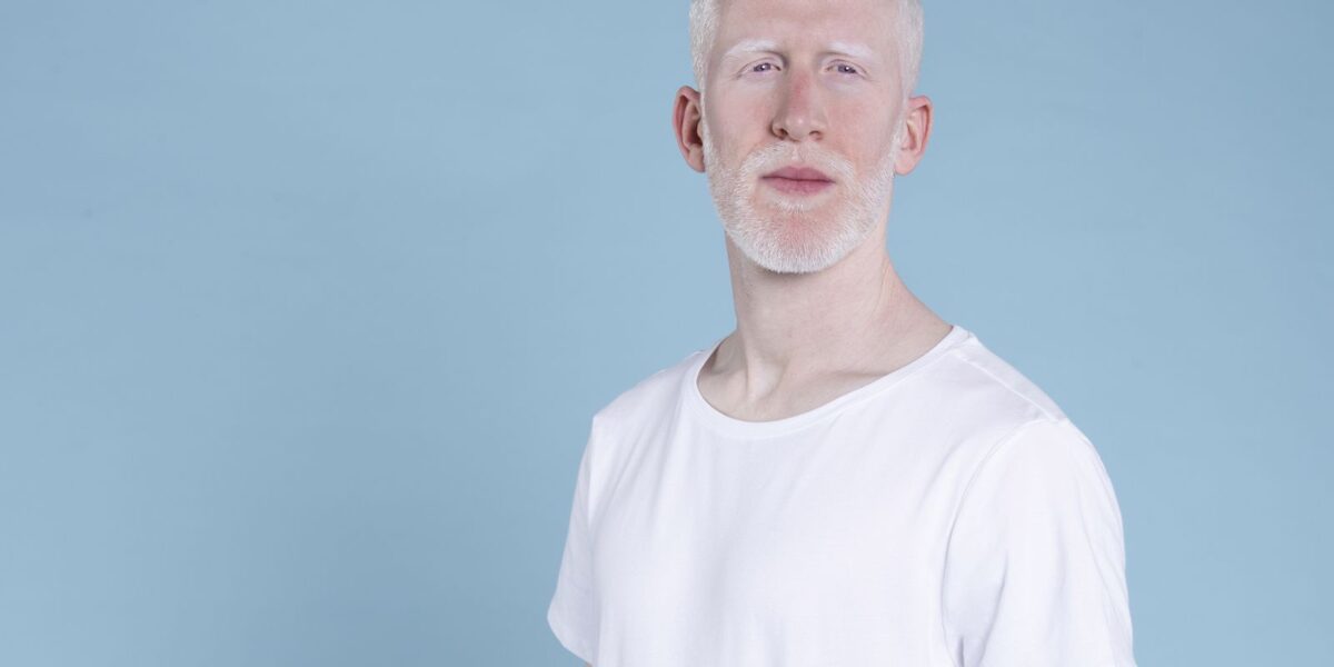 sancionada-lei-que-cria-politica-de-protecao-a-pessoas-com-albinismo