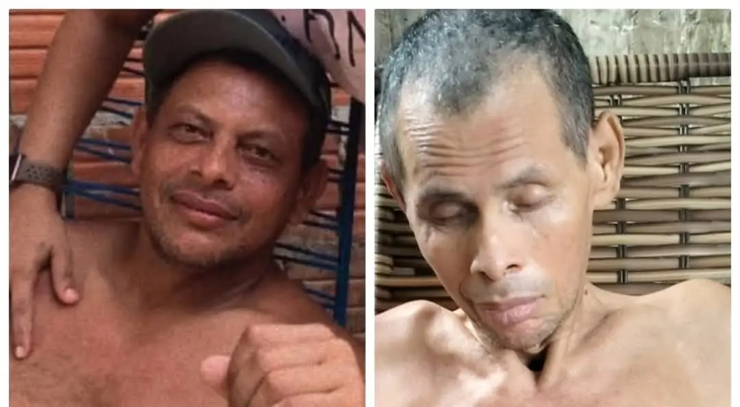 No Acre, homem tem vida transformada após acidente e passa a viver sob cuidados da irmã