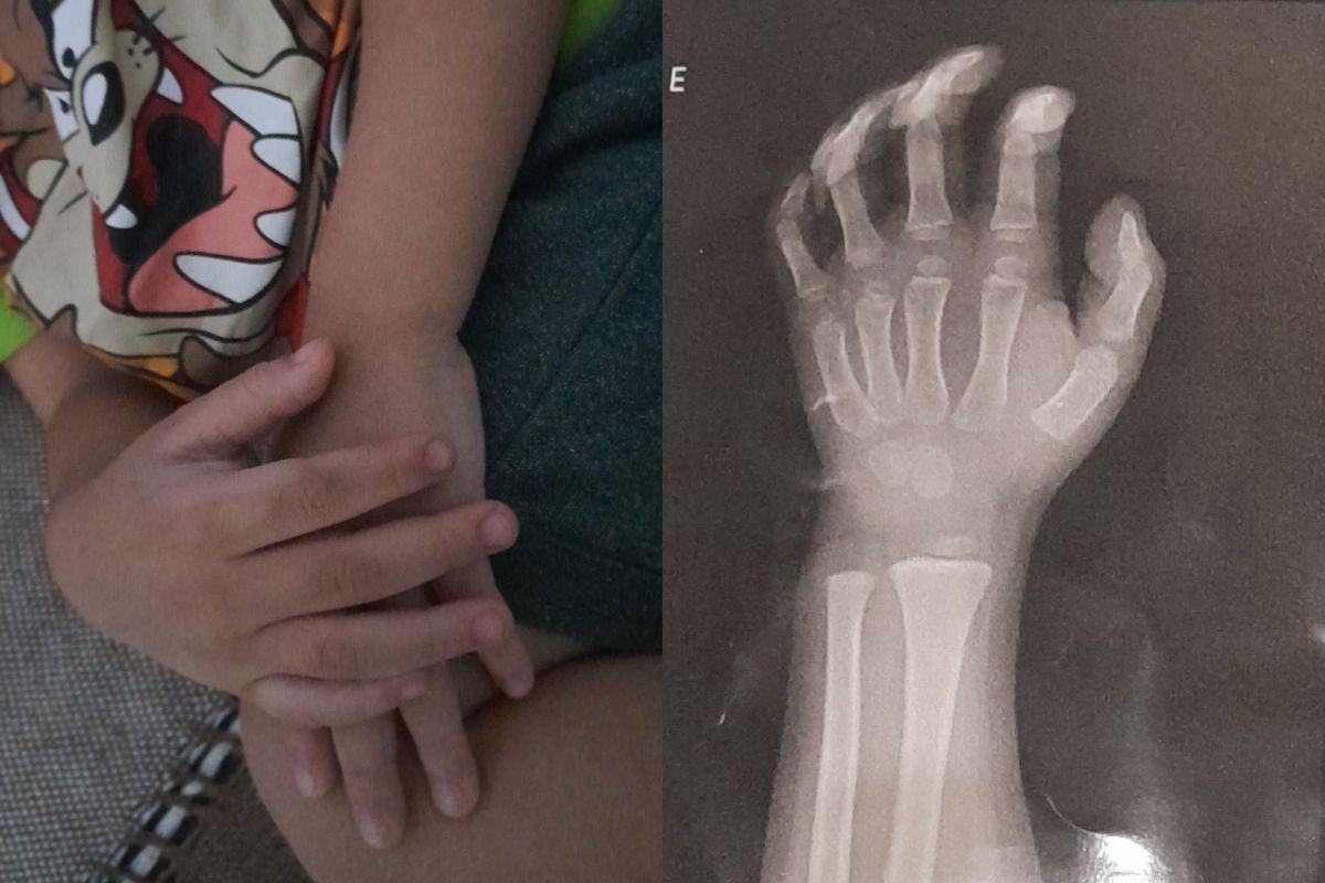 professora-e-demitida-por-luxar-braco-de-crianca-em-creche-no-litoral